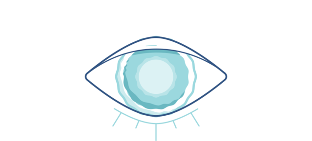 Illustration of a cloudy eye