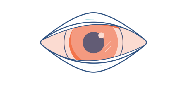Illustration of a sore, red eye